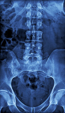 X-ray Image of the Lumbar Spine and Pelvic Area