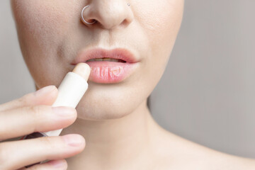 Woman with dry lips, Dry, chapped, dry skin problem with mouth disease, A woman applies a...