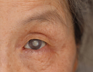 Close up of female elderly body eye (cataract)
