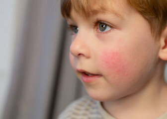 Portrait of a cute little boy with atopic dermatitis on his face