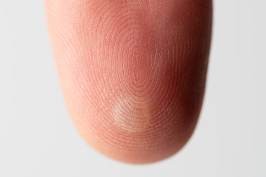 White round blister on finger