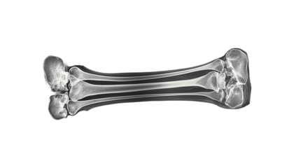 X-ray of the lower leg showing the tibia and fibula png