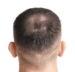Man suffering from baldness on white background, back view