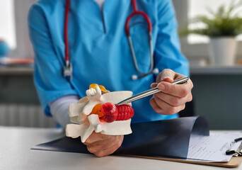 Treatment of intervertebral hernia. Chiropractor with anatomical model of lumbar disc herniation...