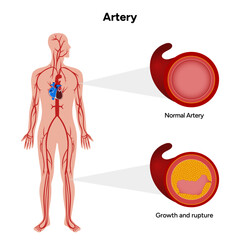 Constricted artery formation of plague, growth and rupture, blood clot and normal artery