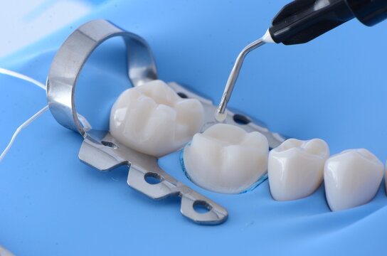 Immediate Dentin Sealing with Rubber Dam
High-quality images showcasing the process of immediate dentin sealing performed under rubber dam isolation. These photos highlight precision and moisture cont
