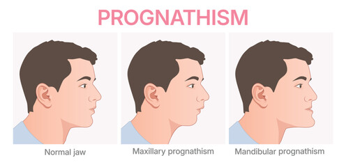 Vector illustration showing deformities of mandibular. Prognathism infographic. Orthognathic surgery. © Daria