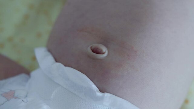 Convex navel on the stomach of a newborn baby, close-up