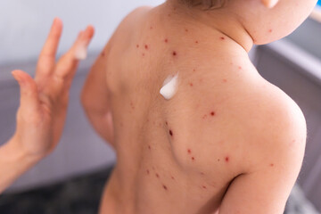 Mother applies medicine to a small child's skin for chickenpox spots