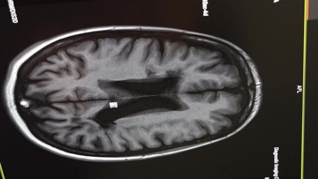 MRI brain scan. Medical, science and education mri brain. Magnetic resonance. MRI blood vessels brain, cerebrovascular disease.