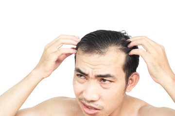 Fototapeta premium Young man serious hair loss problem for health care medical and shampoo product concept