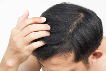 Young man serious hair loss problem for health care medical and shampoo product concept