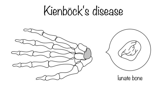 Kienb&ouml;ck's disease