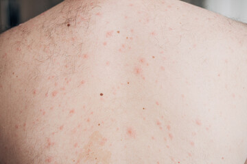 Fototapeta premium Adult man back and body with strong aggressive varicella or chicken pox. Pink spots, papules, vesicles. 