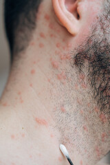 Adult man neck and body with strong aggressive varicella or chicken pox. Pink spots, papules,...