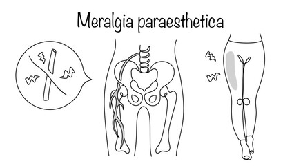 Meralgia paraesthetica