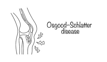 Osgood–Schlatter disease