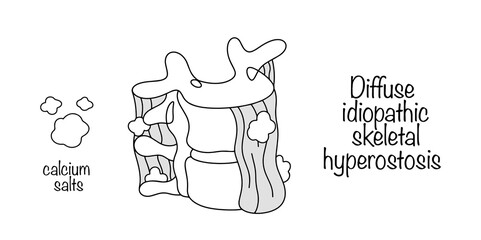 Diffuse idiopathic skeletal hyperostosis