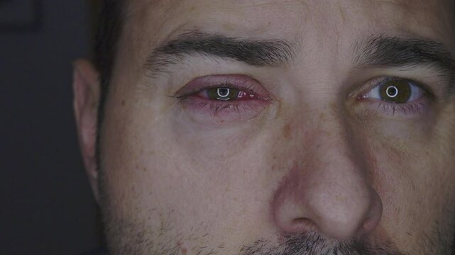 Close-up of the irritated eye of an adult man affected with hemorrhagic conjunctivitis. Capillaries and red petechiae on the sclera
