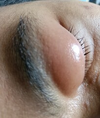 Fototapeta premium close up of an ear of a person,Swollen eye disease, often occurs because there are mites in the eyes, a kind of small animal that is sometimes invisible to the naked eye, sometimes feels hot and cause