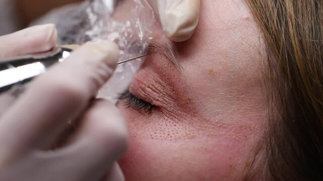 Plasma pen treatment removing wrinkles
