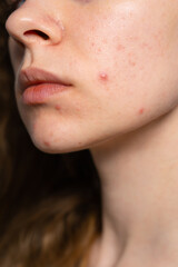 Obraz premium real acne, pimples, black dots close-up, high detail, unrecognizable photo of a woman's face, no make up, no retouch, natural skin, problematic