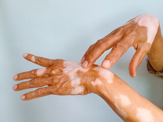 Close up of Old woman hands with skin problem called Vitiligo, isolated on white background