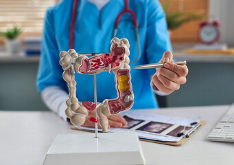 Colon diseases and colorectal cancer and ulcerative colitis