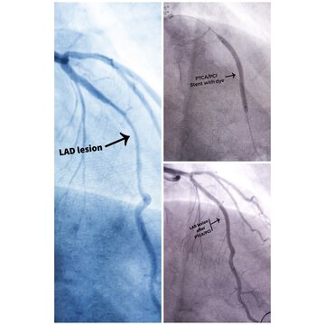 Coronary angiogram and PTCA or PCI of LAD of left coronary artery during cardiac catheterization with contrast dye. Abnormal findings. Colour adjust. Stenting.