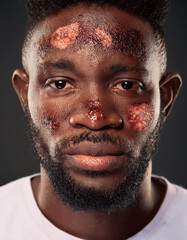 Obraz premium Necrotizing fasciitis on face