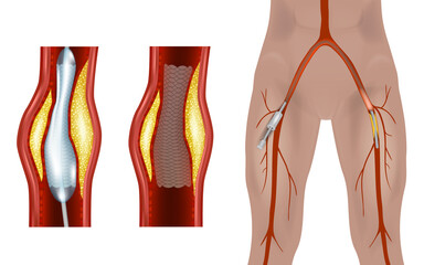 Femoral Endovascular Procedure. Illustration depicting the femoral arteries and popliteal arteries. Angioplasty femoral artery