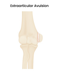 Causes of Extra Articular Avulsion Fracture