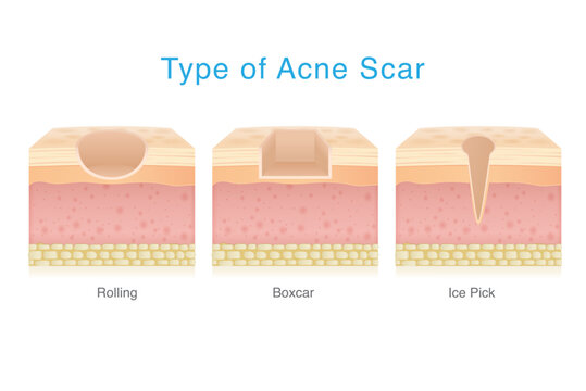Types of acne scar on facial skin layer. Rolling, Boxed and Icepick scars isolated white background. 3D vector Medical diagram about skin problem from acne.