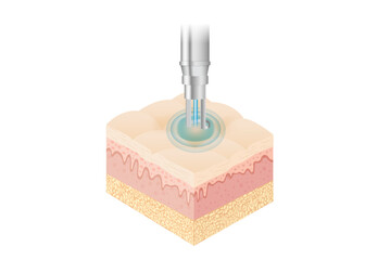 Shoot the Laser pulse on skin into deep layer for treatment skin problems. Illustration about dermatology technology for reduce a wrinkle, scar and dark spot on facial.