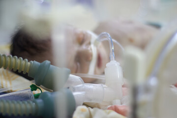Closeup lovely little newborn baby infant lying in incubators for newborns, Newborn baby having the the breathing problem after birth, newborn in NICU, Neonatal intensive care unit.