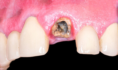 Fototapeta premium broken frontal tooth