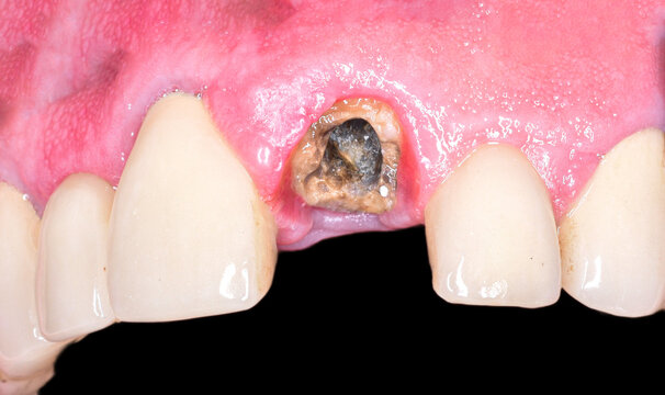 broken frontal tooth
