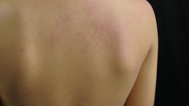 Close-up footage of a person's upper back showing a widespread skin rash.  Redness and raised bumps are visible.