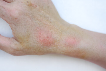 Naklejka premium Right hand of Asian woman with red swelling from hornet sting on skin background