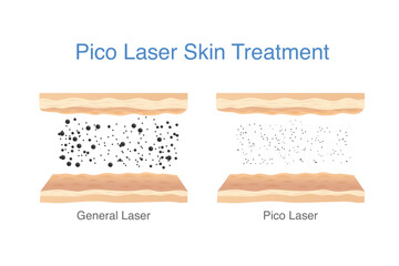 Reduce freckles, blemishes, wrinkles and spots by Picosecond Laser breaks down pigmentation in skin layer into smaller fragments. Medical laser called Pico.