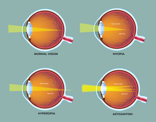 Illustration of most common eye disorders diagram © zombiu26
