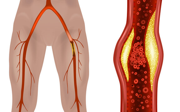 Atherosclerosis of the extremities. Peripheral Leg artery disease. Disease of the peripheral blood vessels that is characterized by narrowing and hardening of the arteries