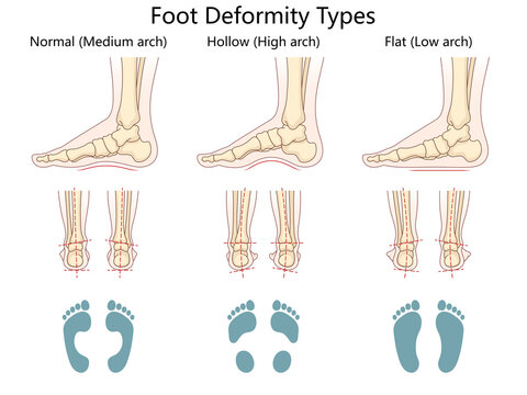 foot deformity types, normal arch, hollow high arch, and flat low arch, anatomical and footprint views diagram hand drawn schematic raster illustration. Medical science educational illustration