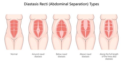 diastasis recti, including around-navel, below-navel, above-navel, and full-length abdominal separations diagram hand drawn schematic raster illustration. Medical science educational illustration