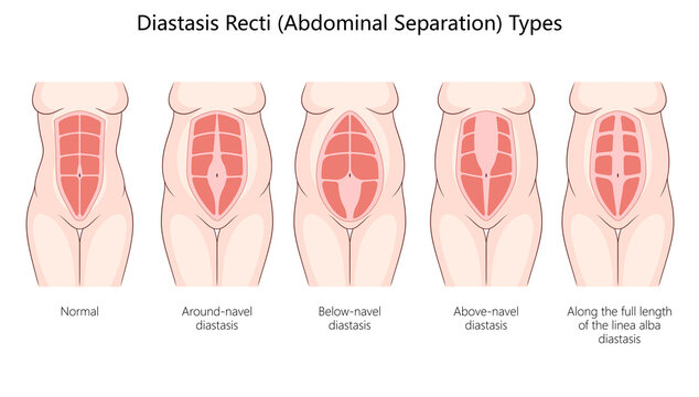 diastasis recti, including around-navel, below-navel, above-navel, and full-length abdominal separations diagram hand drawn schematic raster illustration. Medical science educational illustration