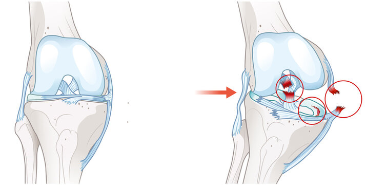 The knee's unhappy triad. Tears of the ACL, MCL, and medial meniscus. Sports injury. Labeled medically illustration