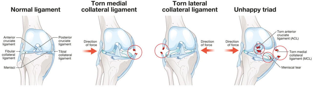 The knee's unhappy triad. Tears of the ACL, MCL, and medial meniscus. Sports injury. Labeled medically illustration