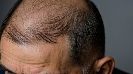 Fototapeta premium man's scalp with severe hair loss, showcasing common hair loss pattern symptoms on men, such as receding hairline, thinning crown, and balding spots