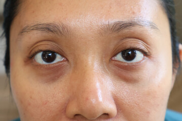 young woman face has dark bags under her eyes. Swelling of the lower eyelid and deep. Unhealthy...