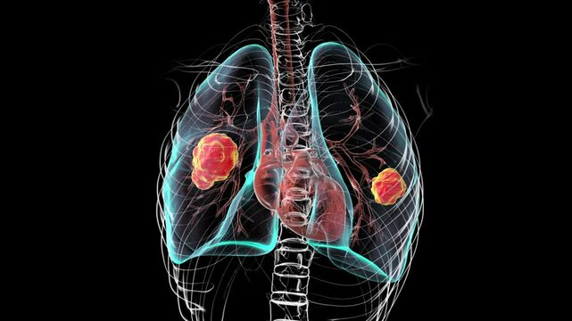 Lung mucormycosis, 3D animation showing fungal infection caused by Mucorales fungi, highlighting multiple irregular lung nodules.